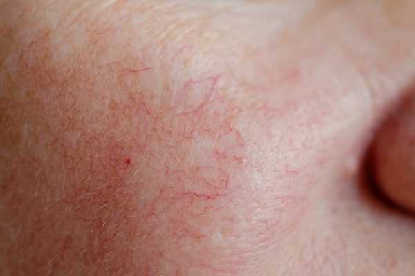 Arañas vasculares en la cara