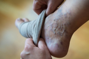 las varices en hombres
