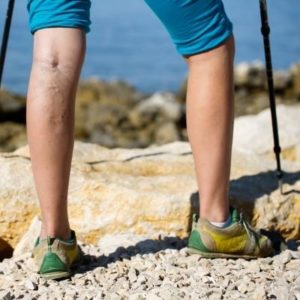 varices en hombre causas