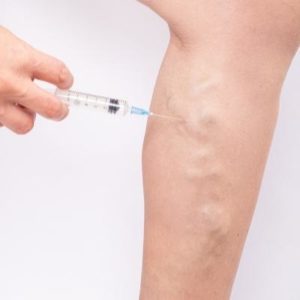 tratamiento de varices en hombres