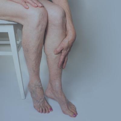 Arañas vasculares en costillas