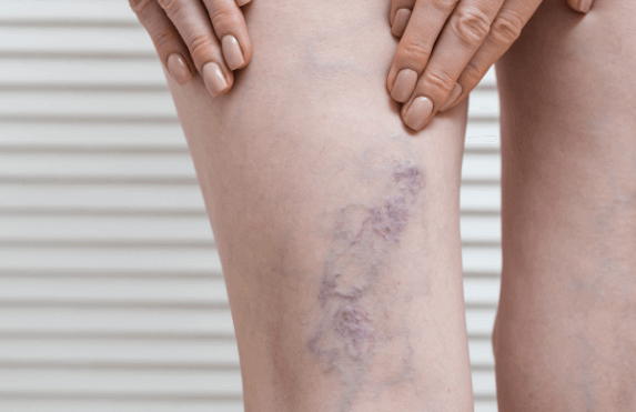 el ejercicio para mejorar las arañas vasculares