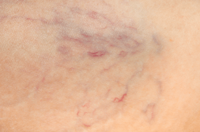 las arañas vasculares en costillas