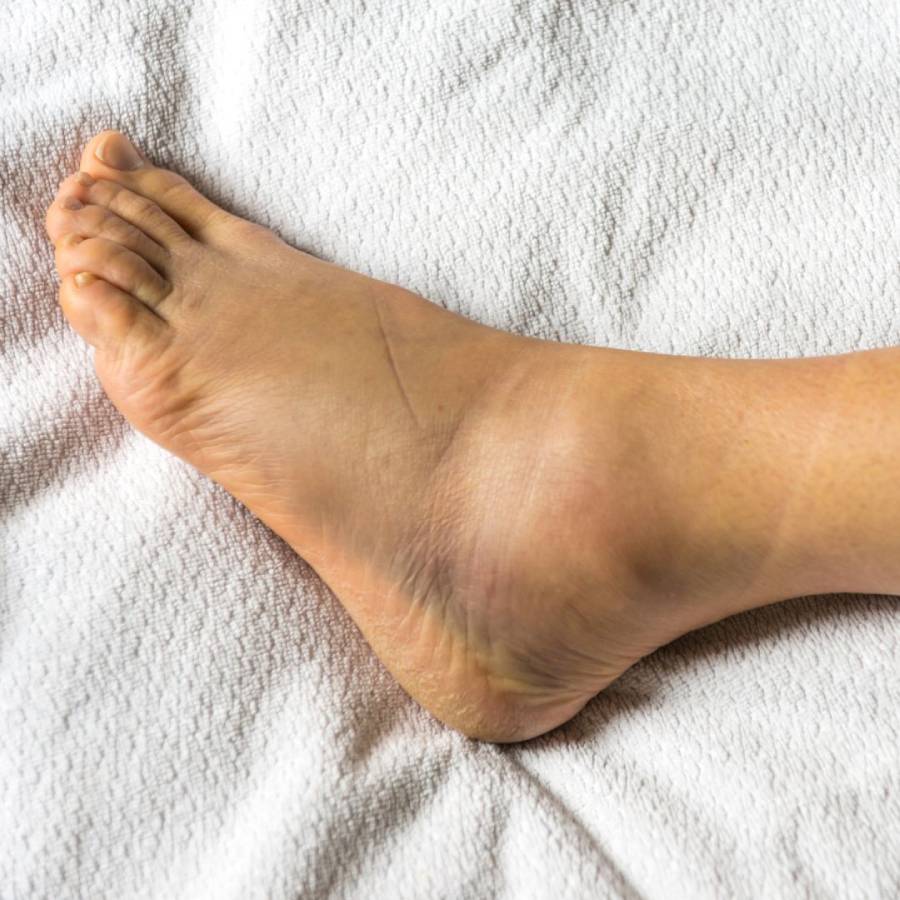 Hinchazón de tobillos