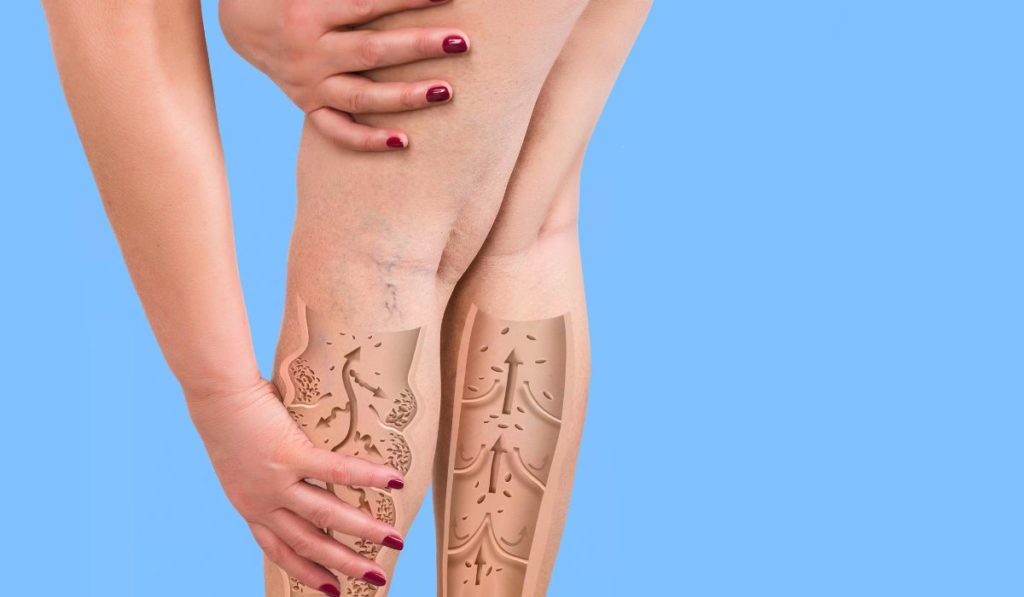 diagnóstico de varices