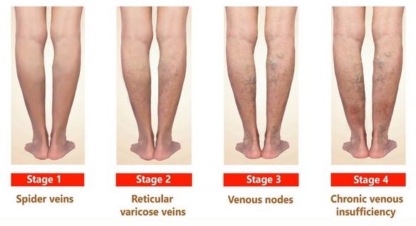 eliminar varices tronculares