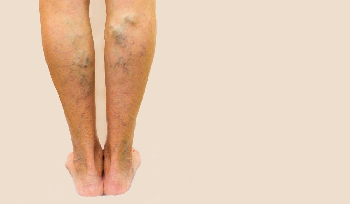 por qué se inflaman las venas