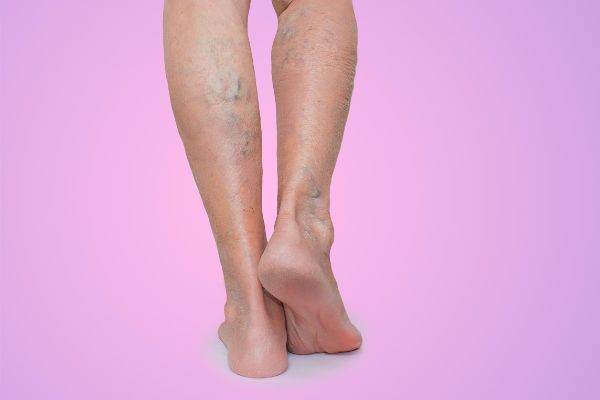 varices en el embarazo