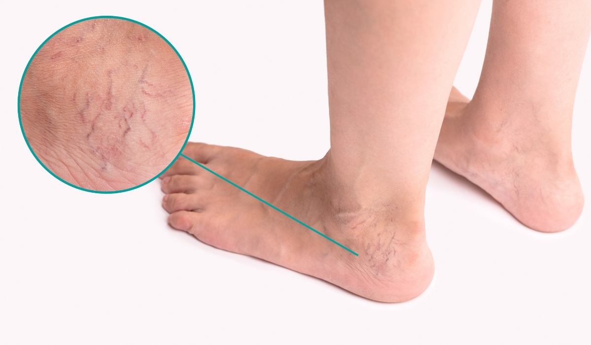 varices en los tobillos