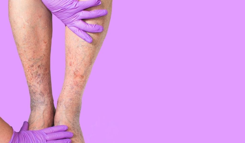 complicaciones varices