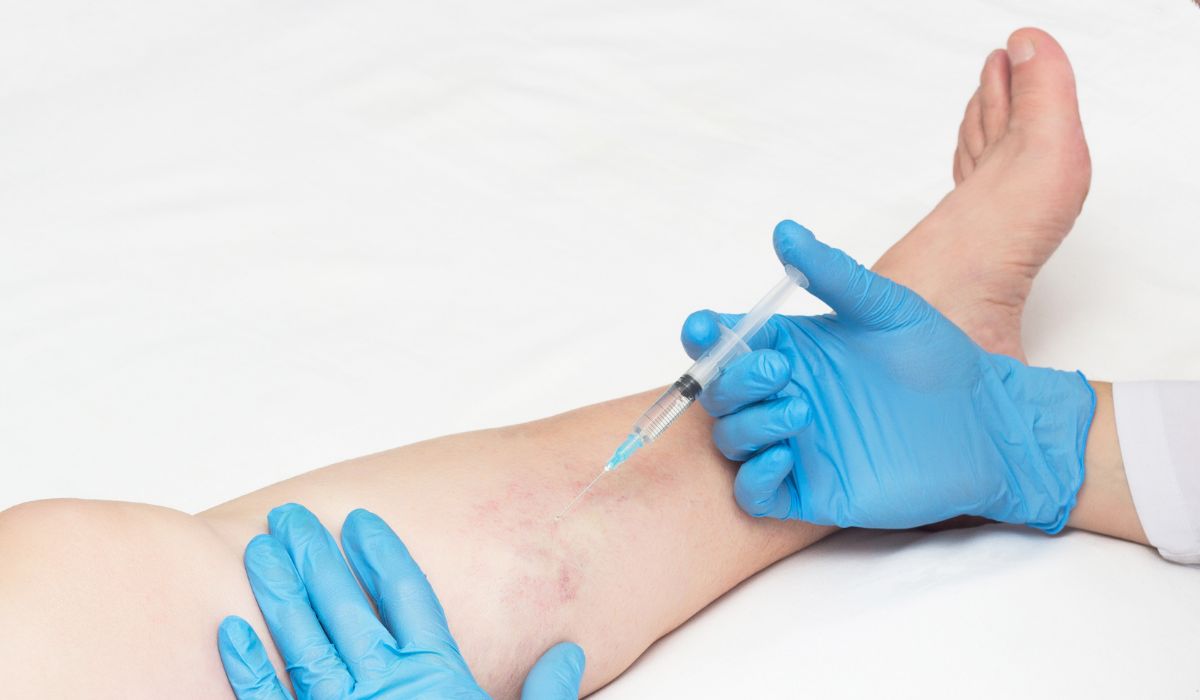 la cirugía de varices