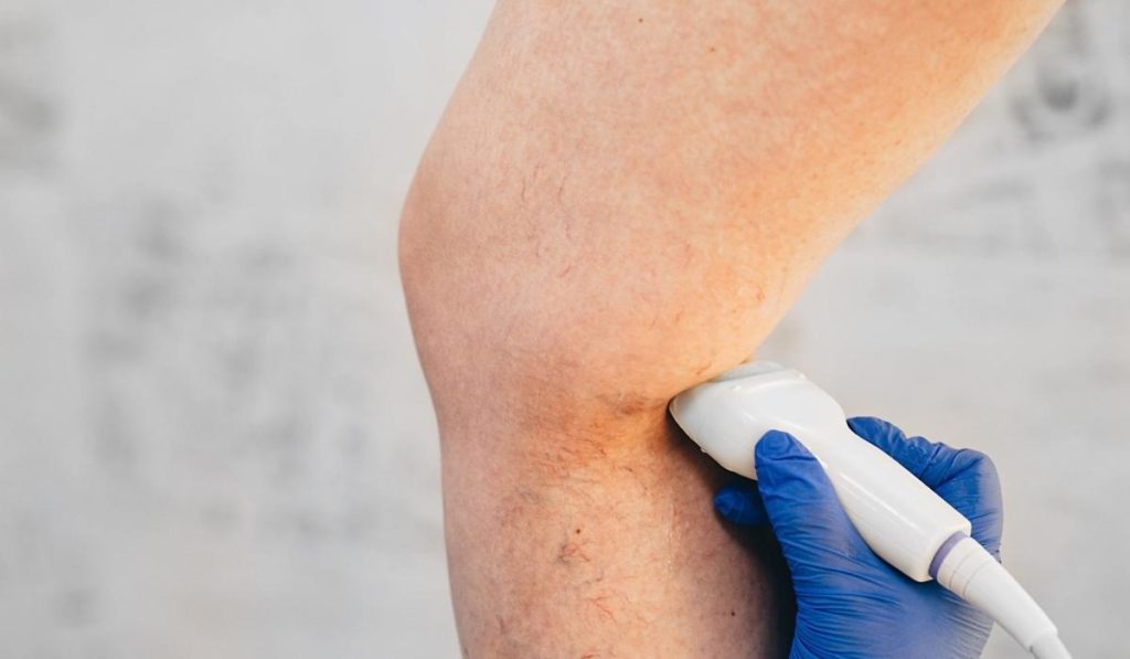 realizar operación varices