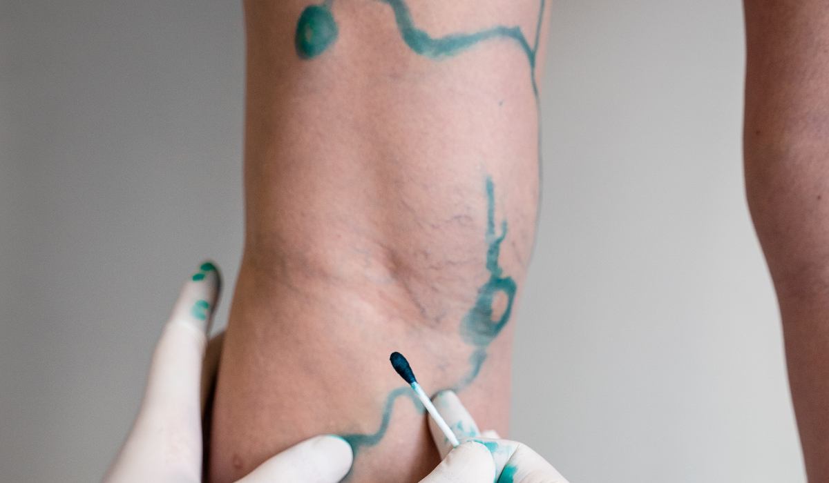 eliminar varices con flebectomía