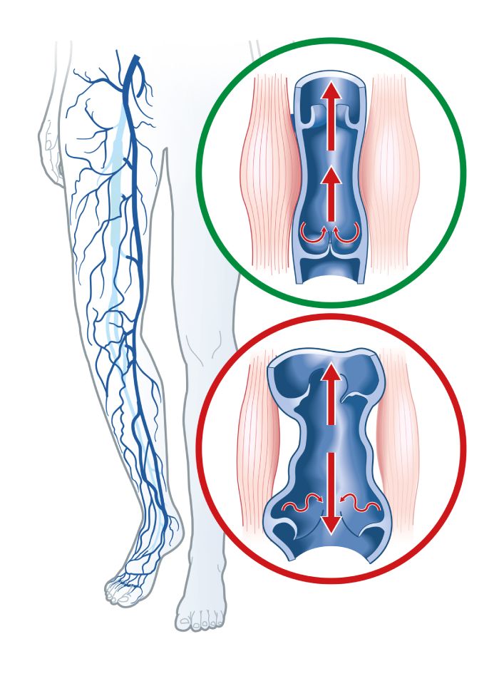 las varices en las piernas
