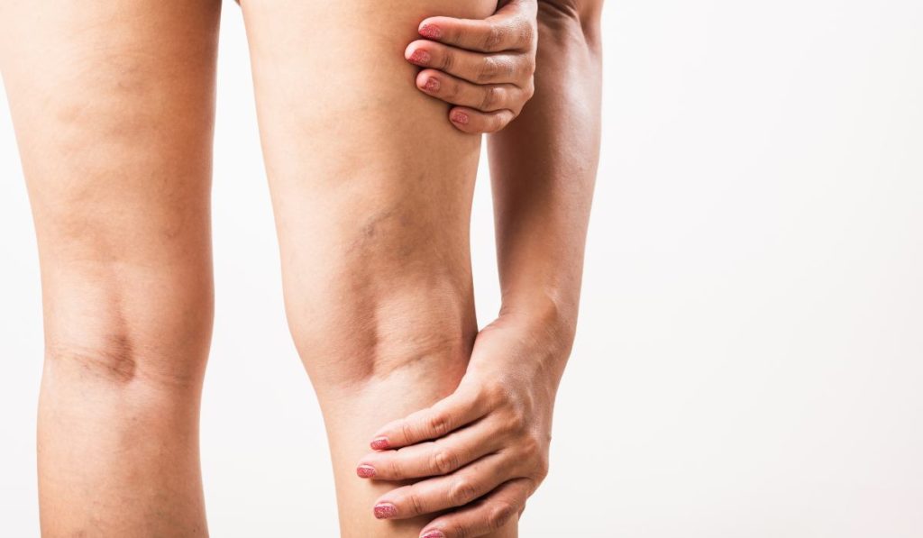 las varices internas dolor