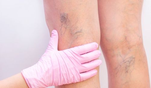 varices marcadas piernas