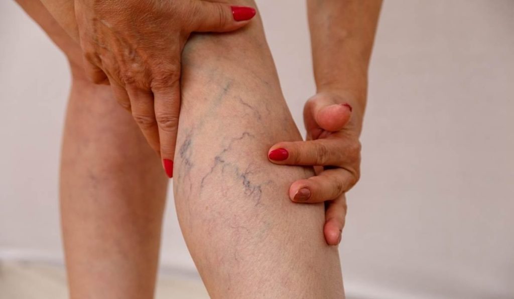 venas varicosas en piernas