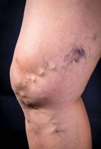 aparición moretón por varices