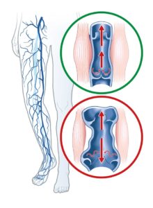moretones por varices tratamiento