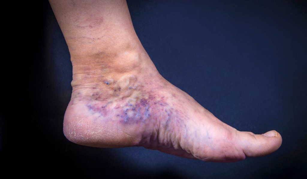 varices moretones piernas
