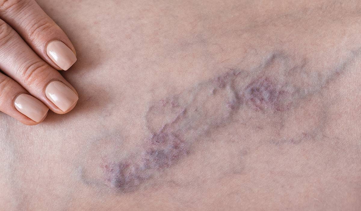 varices y moretones en piernas