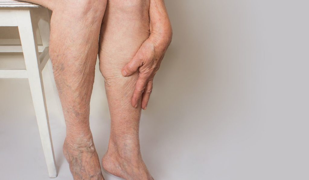 aliviar dolor varices