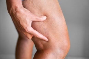 pinchazo en las piernas