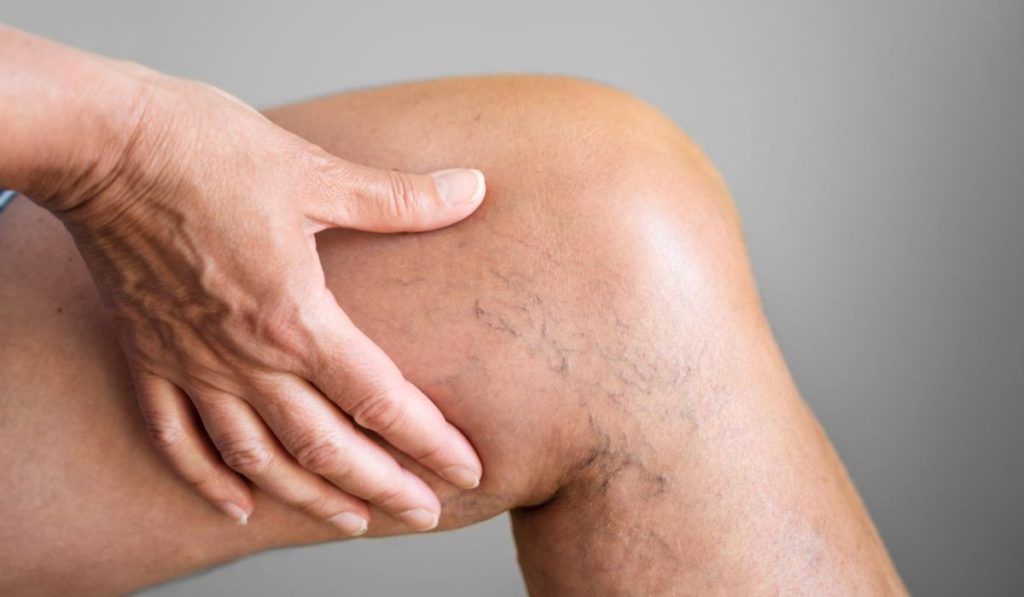 varices en las piernas