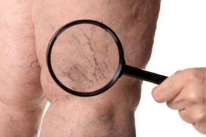 Como evitar las varices