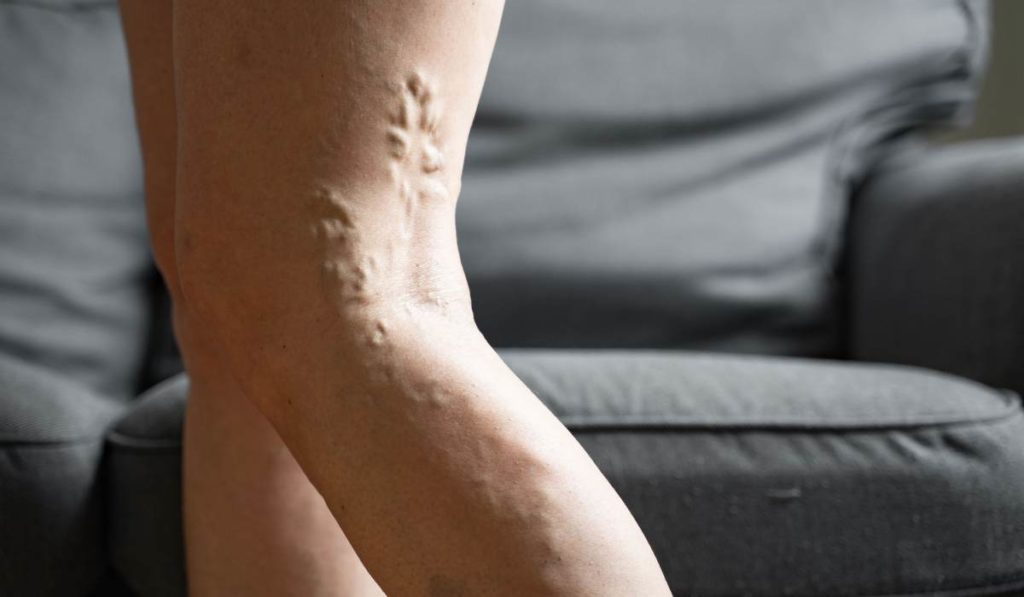 varices y arañas vasculares