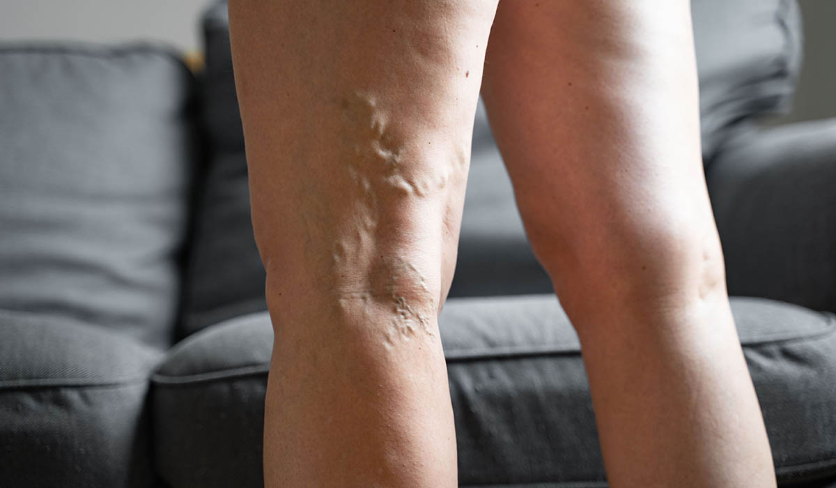 Cuándo preocuparse por las varices en las piernas