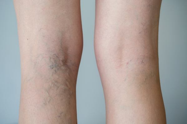 cómo mejorar mis varices