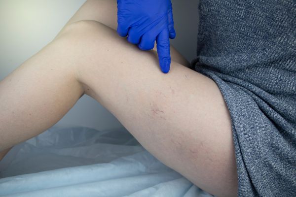 síntomas de dolor en las piernas