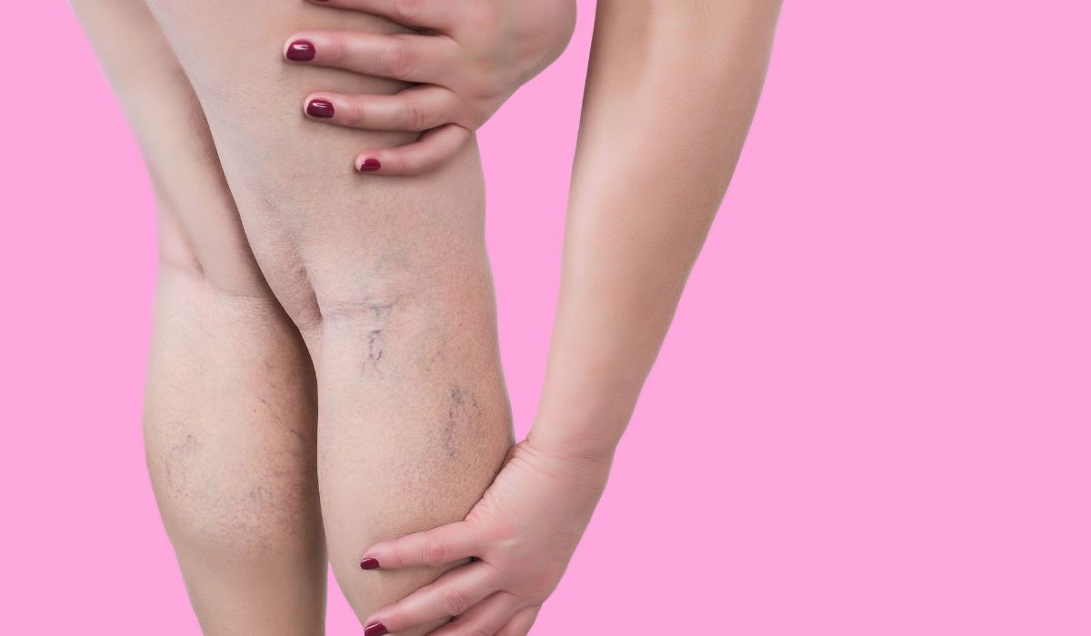 mejor época para eliminar varices