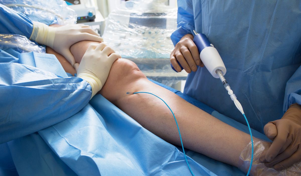 mejor época para tratar varices