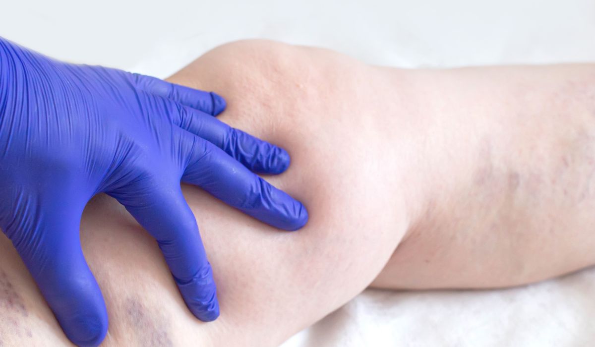 por qué aparecen las varices