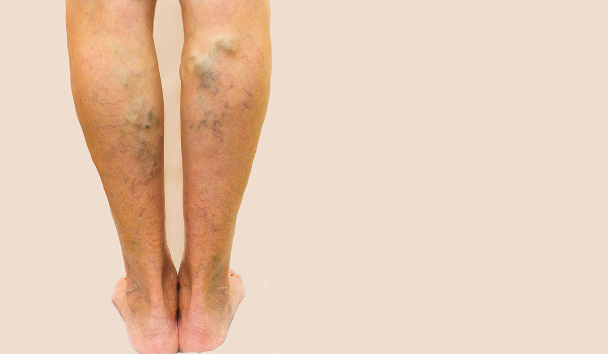 qué son las varices reticulares y cómo tratarlas