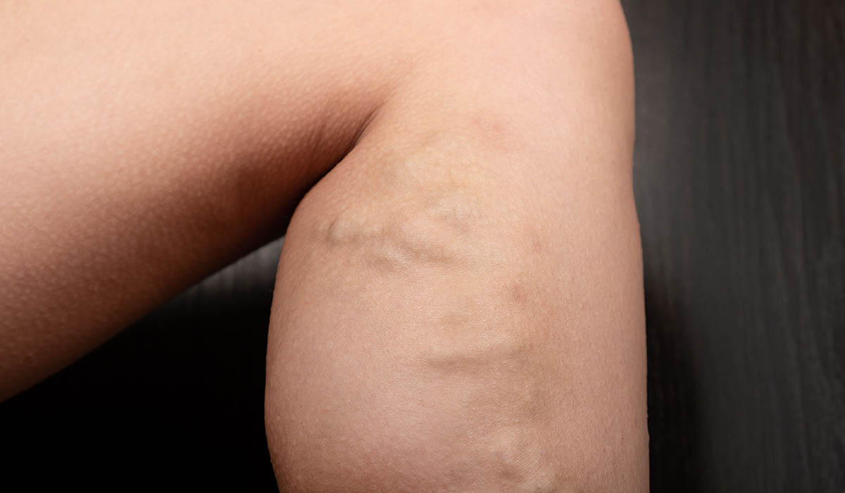 Tipos de varices que existen y cómo tratarlas